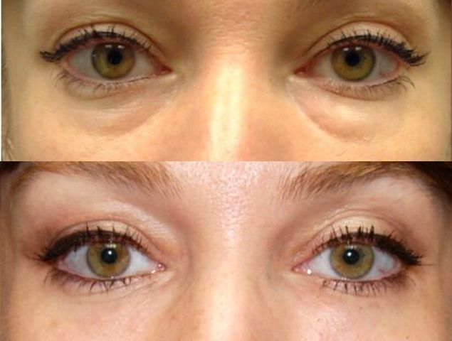 нижняя блефаропластика